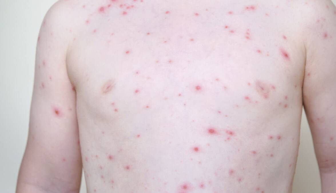 Parents have been urged to look for signs of chickenpox.