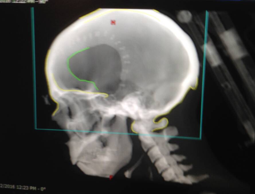 A scan showing where a piece of Murray Silver's skull was removed after he got an staph infection after surgery on his brain.