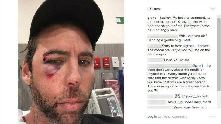 Grant Hackett posted an image of himself to social media on Thursday, his face bloody and bruised. Photo: Instagram