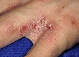 Scabies outbreak confirmed at aged care facility
