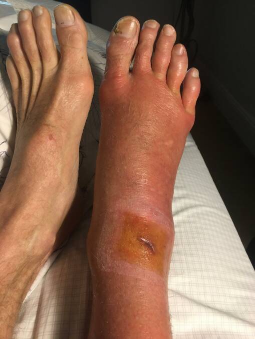 The sting left a gash on Paul Buchanan's right ankle. 