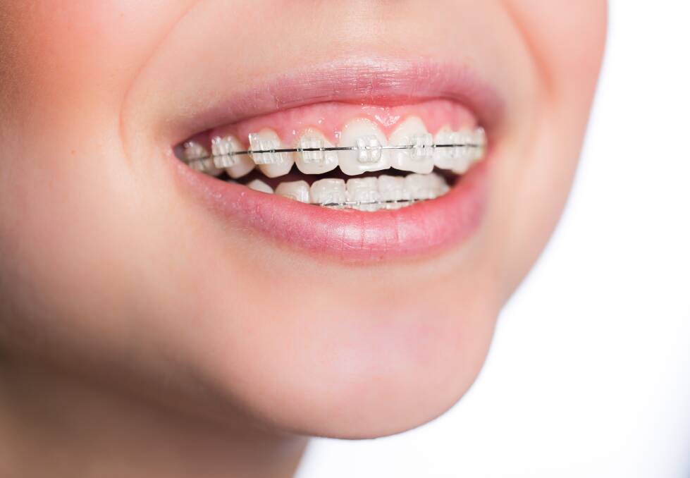 When it comes to teeth straightening it is essential to note that the best option for you will depend on your unique dental needs. Picture Shutterstock