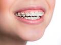 When it comes to teeth straightening it is essential to note that the best option for you will depend on your unique dental needs. Picture Shutterstock