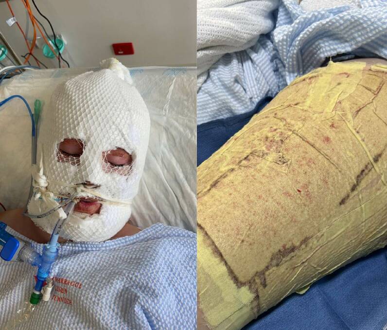 Jesse was in a coma for four days. She then had skin grafts donated from her thigh.