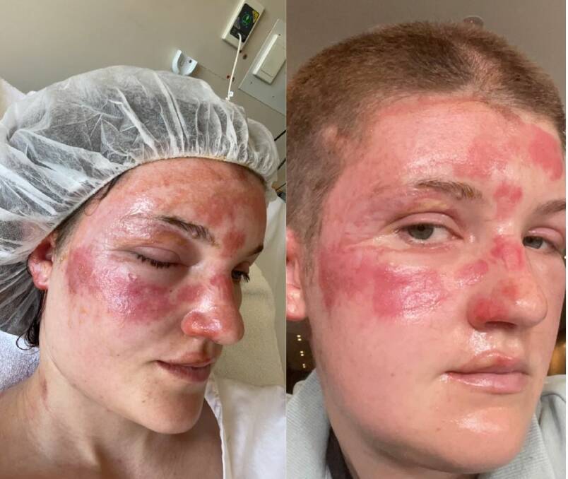 Olivia suffered second-degree burns to her face following the fire and later shaved her head due to damage to her hair. 